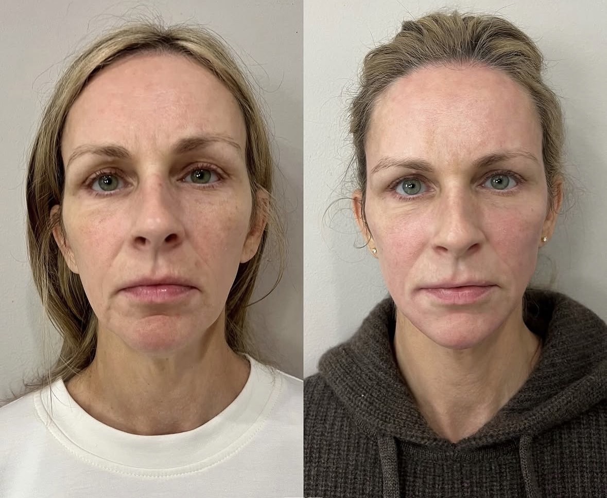 Before and after facial balancing with dermal filler and Botox performed by Jocelyn Brackett, NP, in Virginia.
