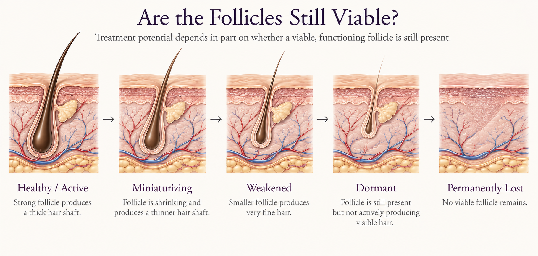 Illustration showing hair follicle progression from healthy and active through miniaturizing, weakened, dormant, and permanently lost stages.