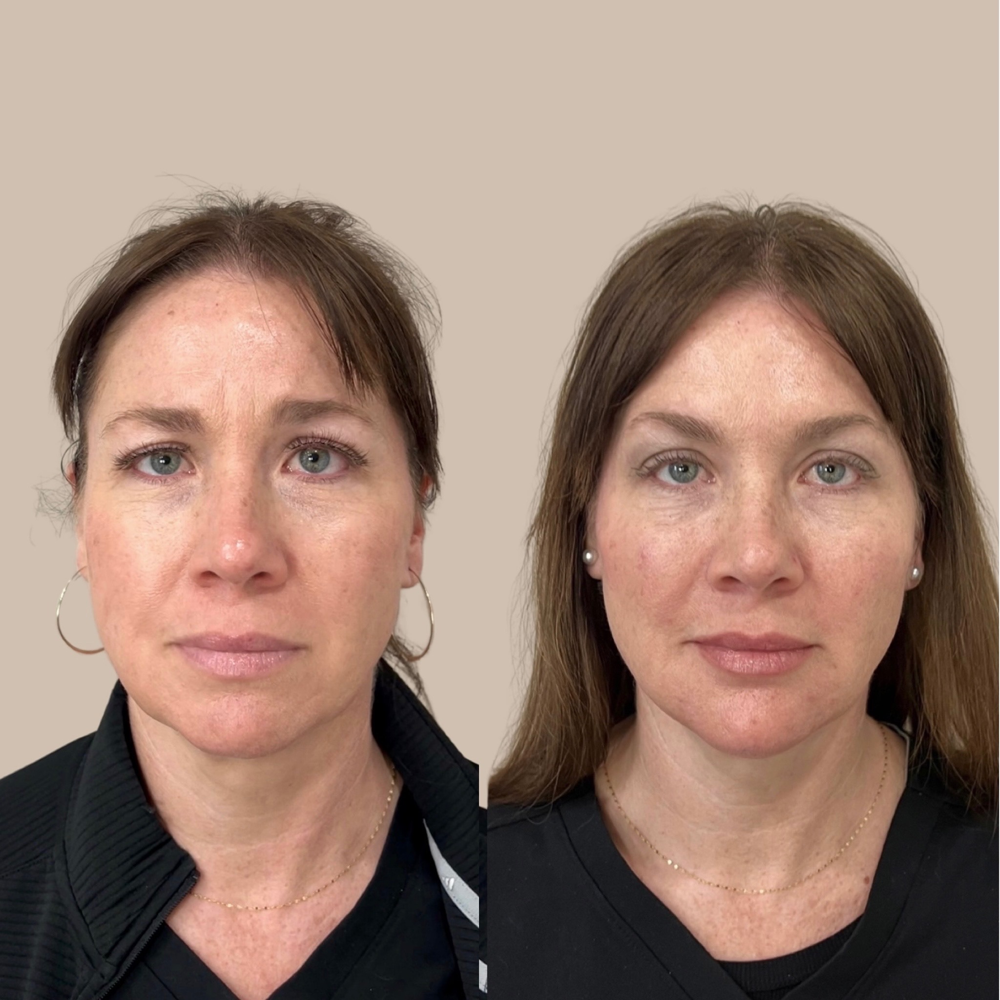 Composite before-and-after photographs of a Virginia facial balancing case treated with neurotoxin and hyaluronic acid dermal filler.