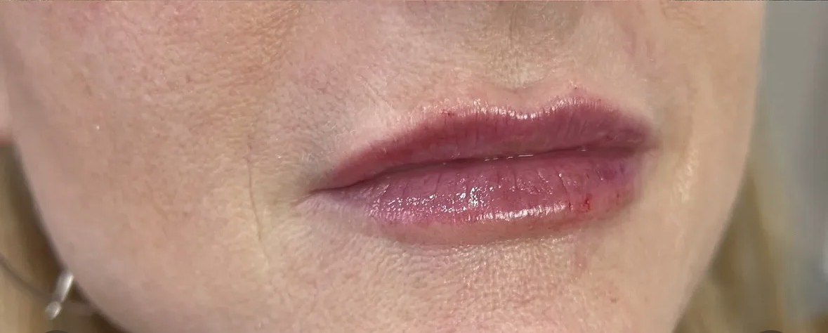 After lip augmentation with dermal filler performed by Jocelyn Brackett, NP.