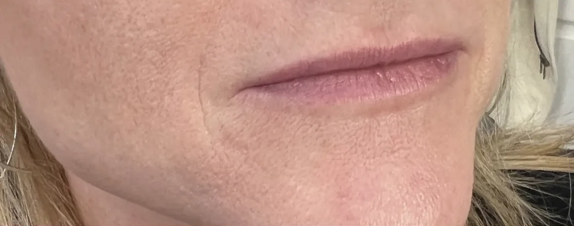 Before lip augmentation with dermal filler performed by Jocelyn Brackett, NP.