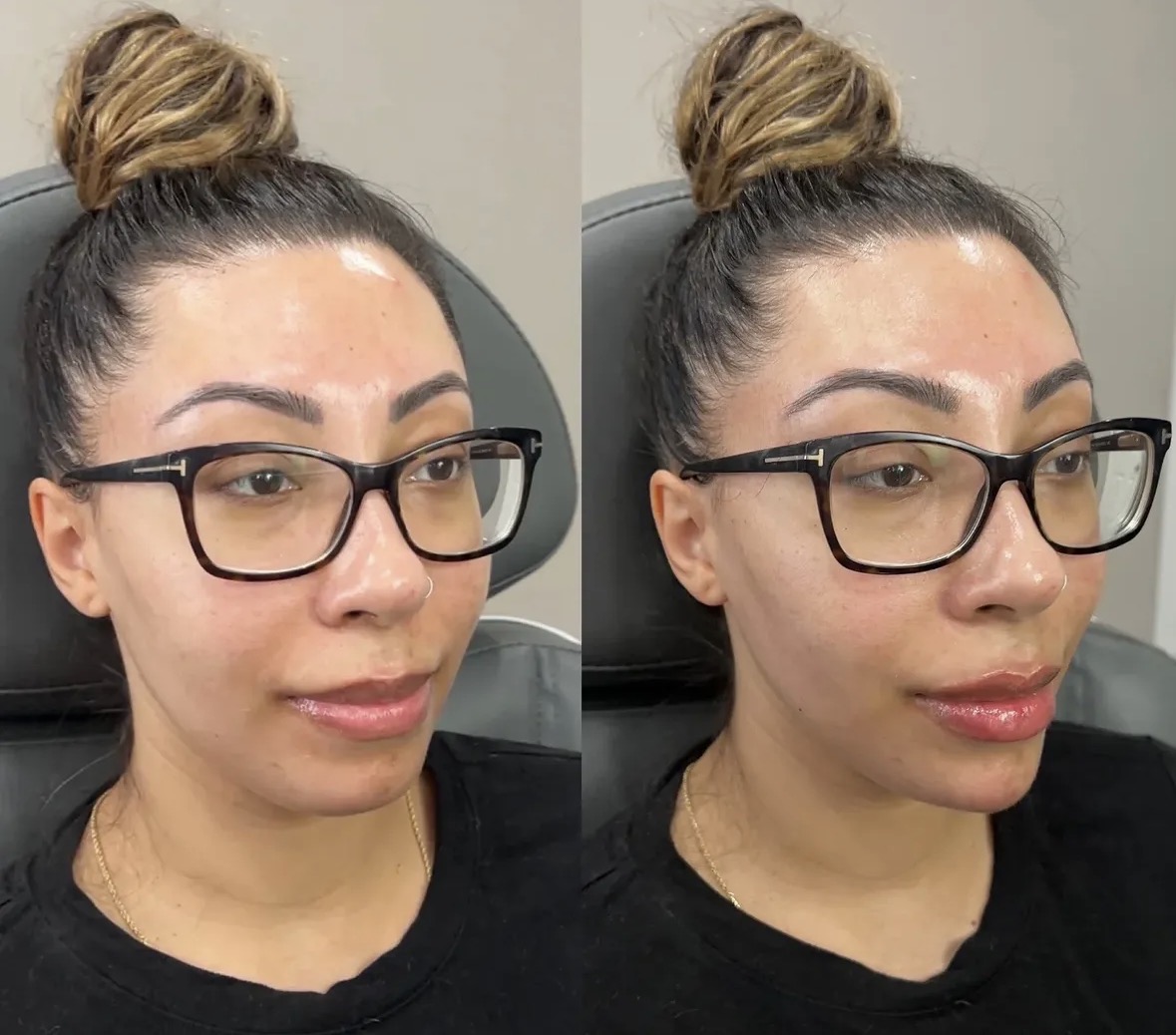 Before and after upper and lower lip and chin dermal fillers performed by Jocelyn Brackett, NP, in Virginia.