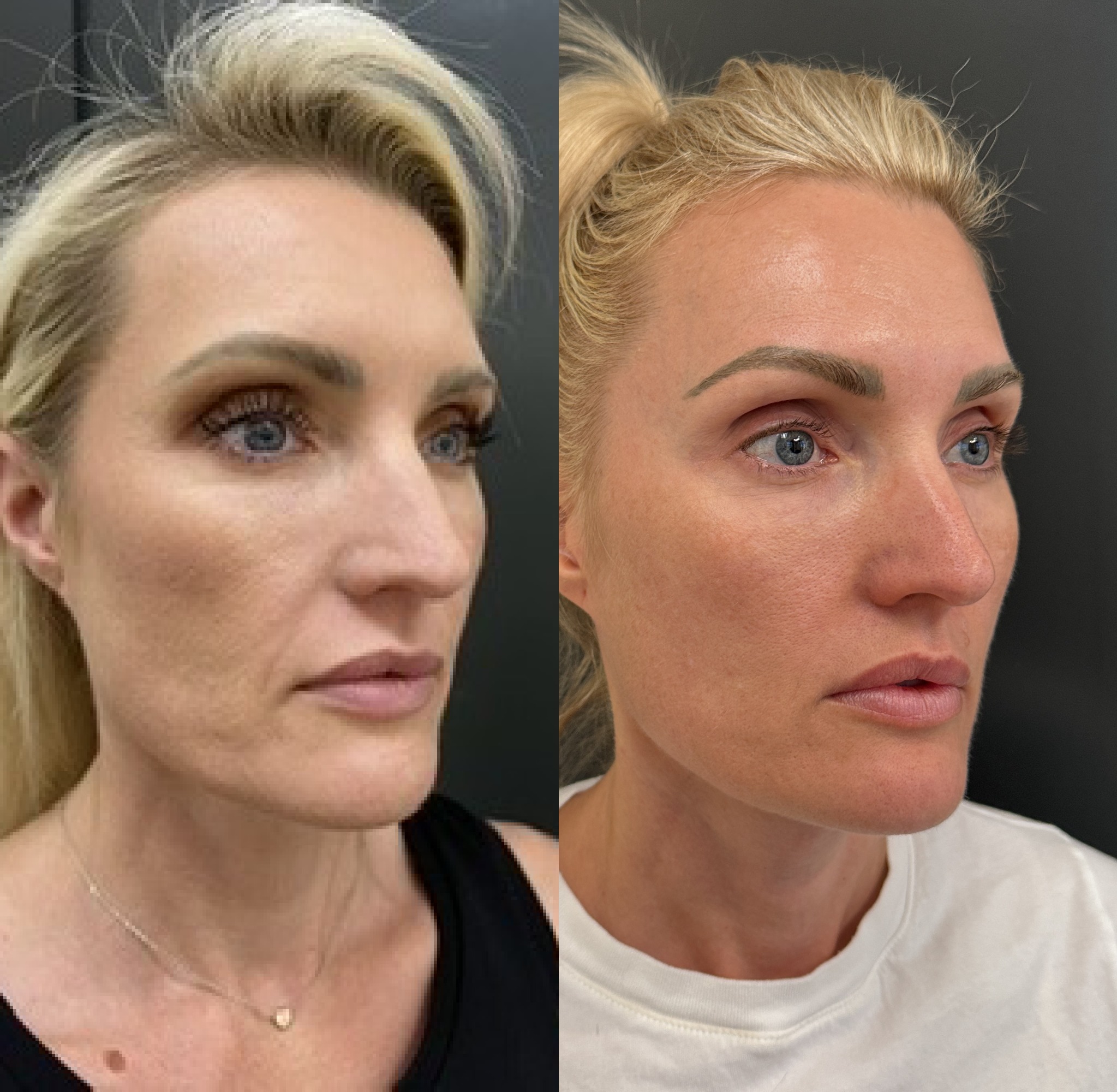 Composite before-and-after photographs showing facial rejuvenation following Matrix Pro treatment.