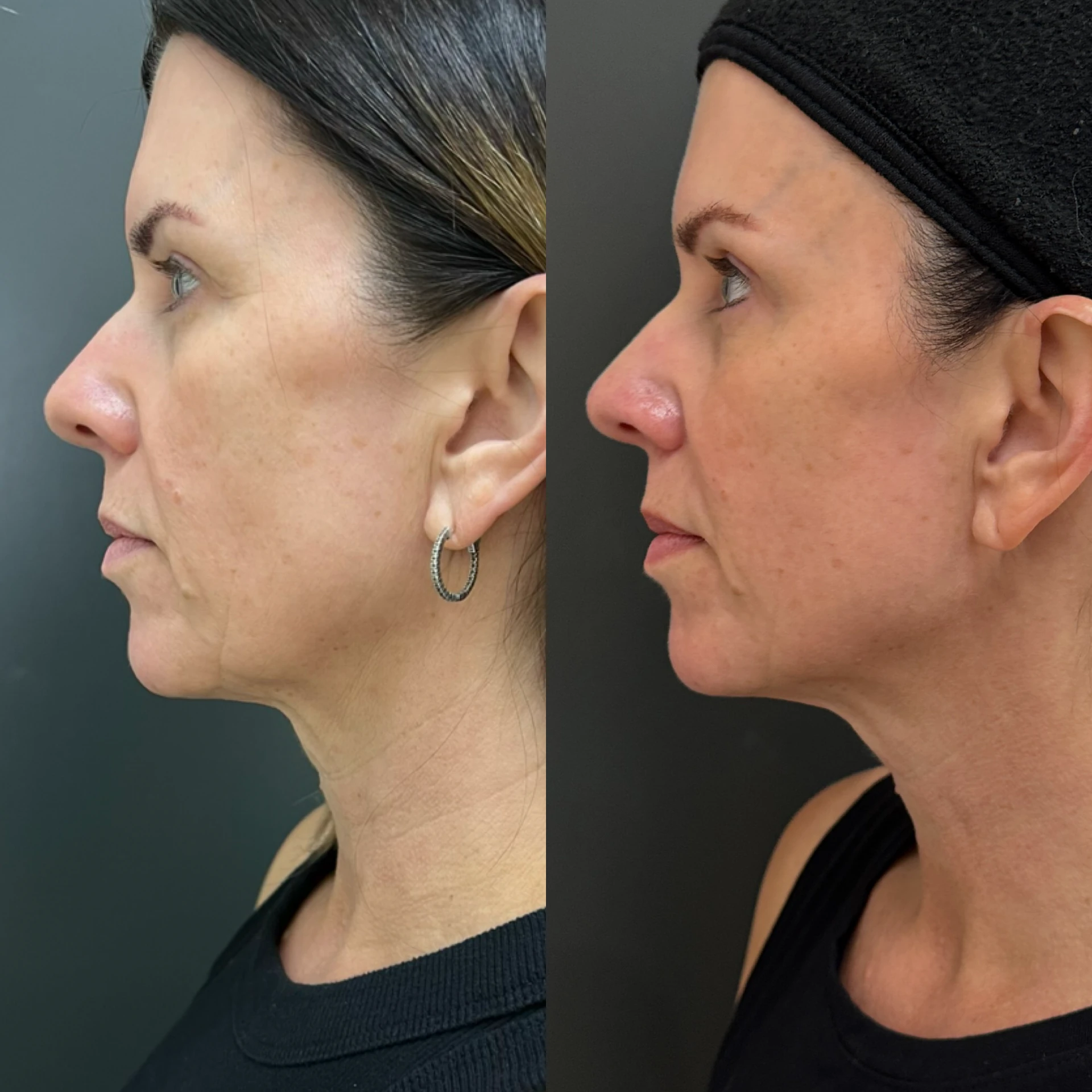 Composite before-and-after photographs showing lower-face, jawline, and neck refinement following Matrix Pro treatment.