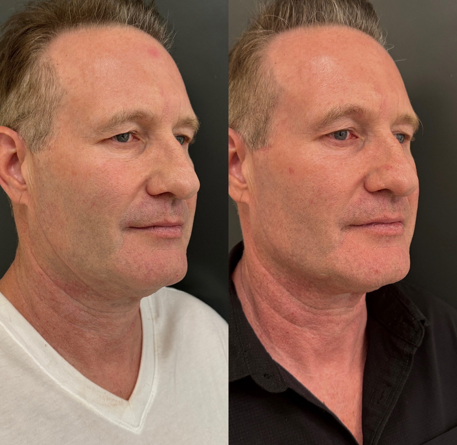 Composite before-and-after photographs of a lower face and jawline refinement case following one Matrix Pro treatment.