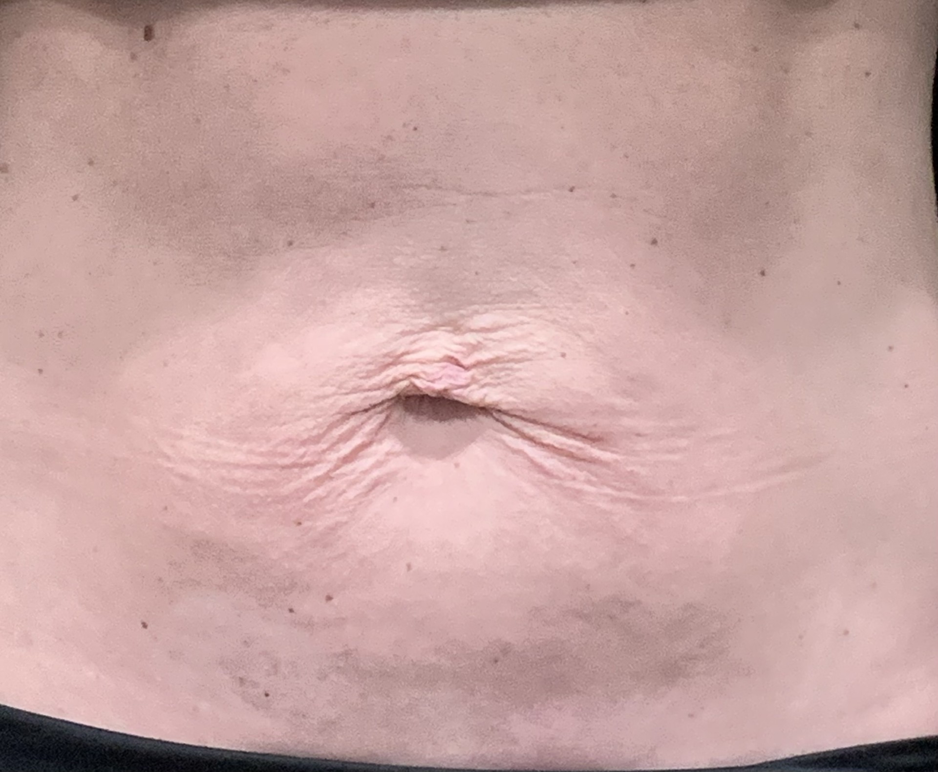 Before abdominal skin tightening with Profound performed by Dr. Scott Gerrish, DO.